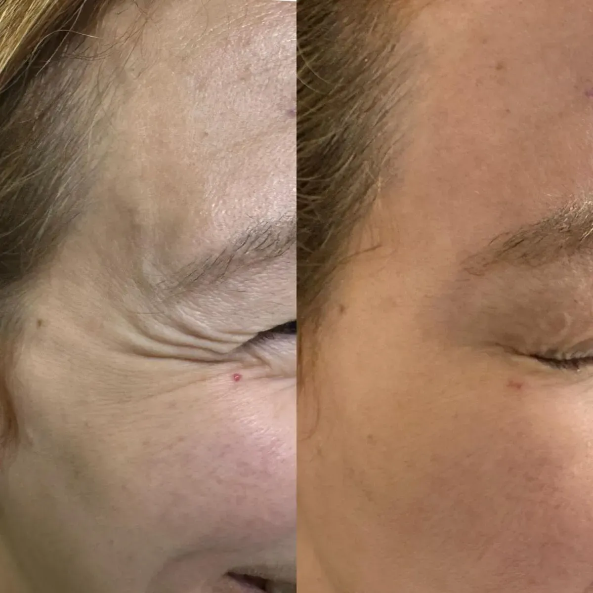 Botox for crow's feet before and after