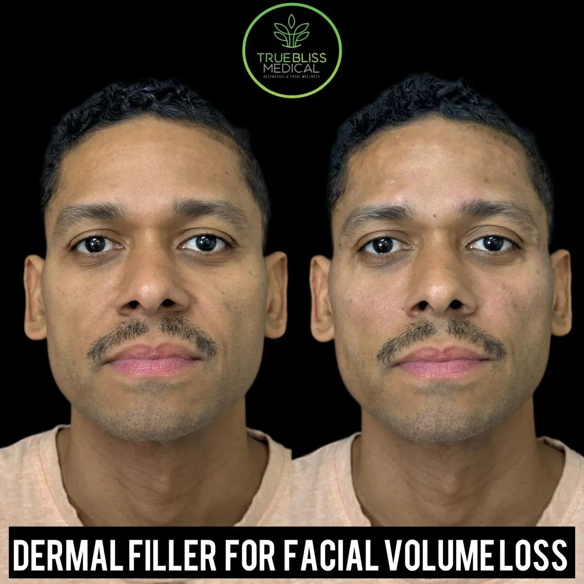 Dermal filler for facial volume loss before and after