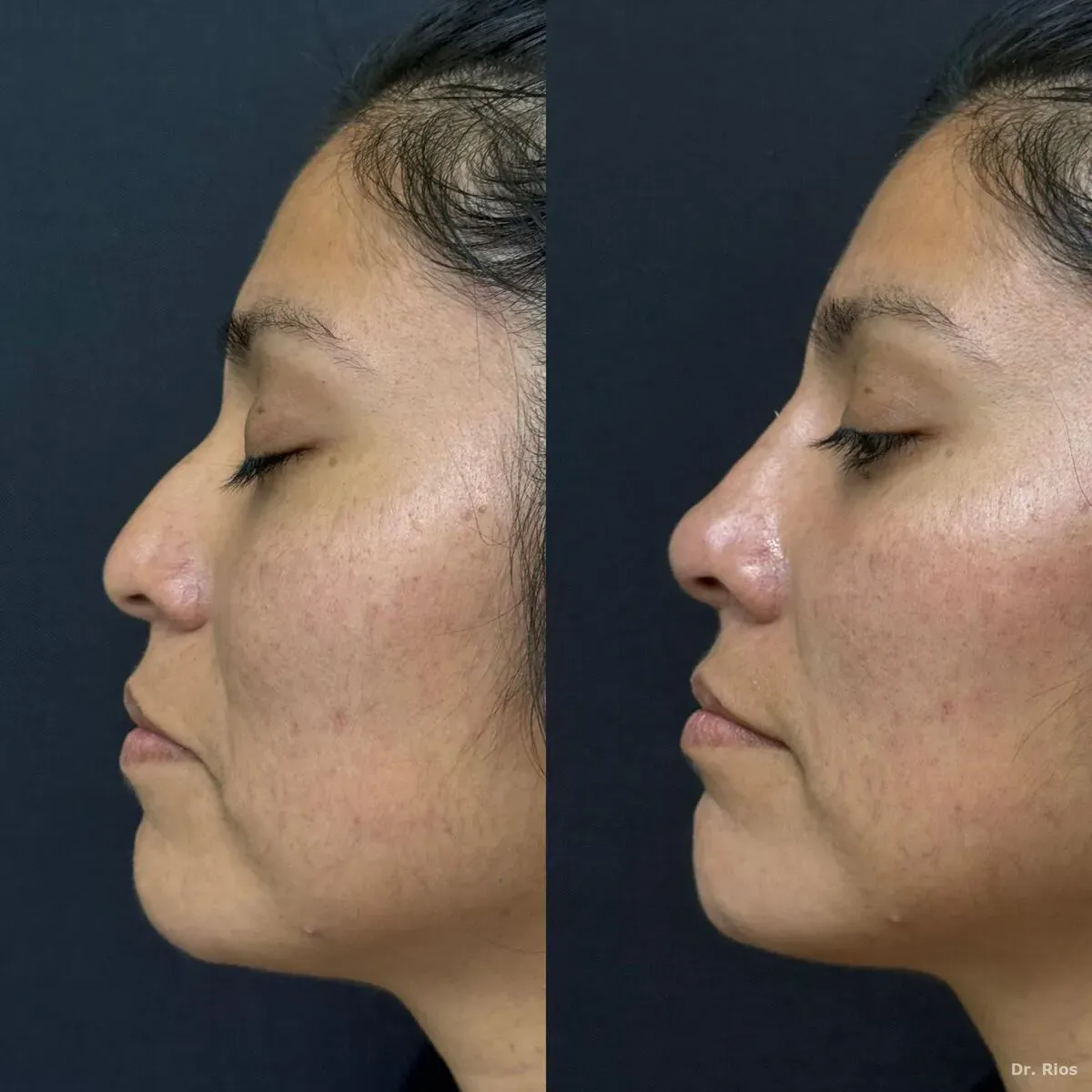 Nose and chin balancing before and after