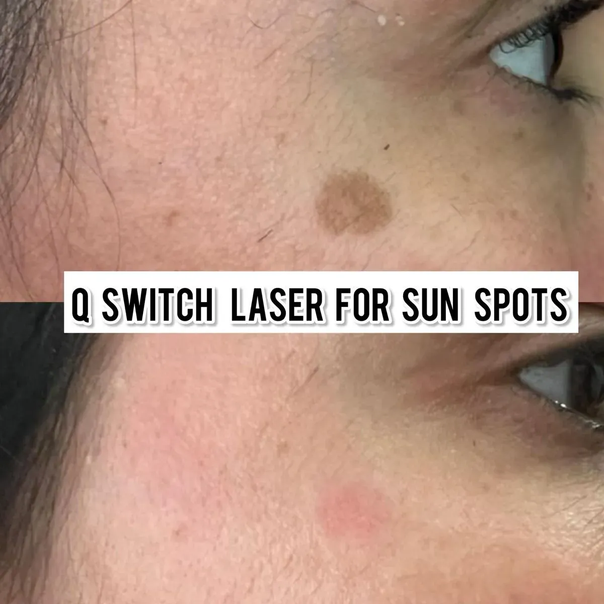 Q-Switch laser for sun spots before and after