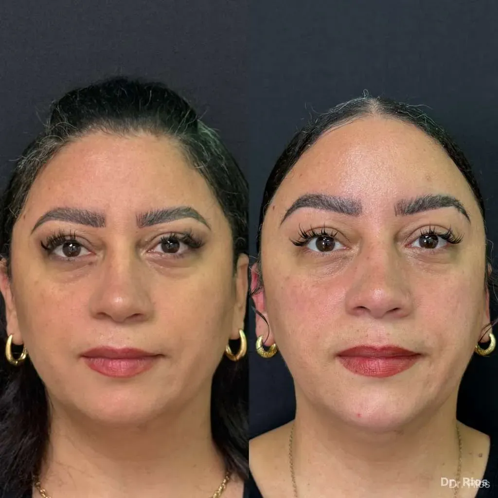 Facial rejuvenation before and after result